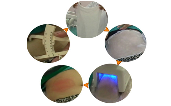 Επεξεργασία procedure.jpg Cryo