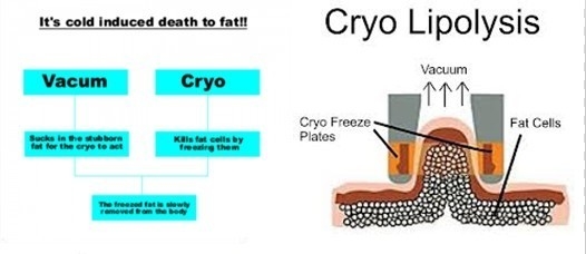 Τιμή εργοστασίων!!! Νέα Cryolipolysis RF μηχανή αδυνατίσματος δημιουργίας κοιλότητας κενή